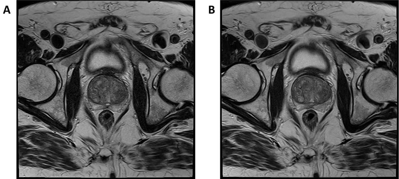 Case study 3: Deep Resolve Boost in prostate imaging on Siemens Sola (XA51)