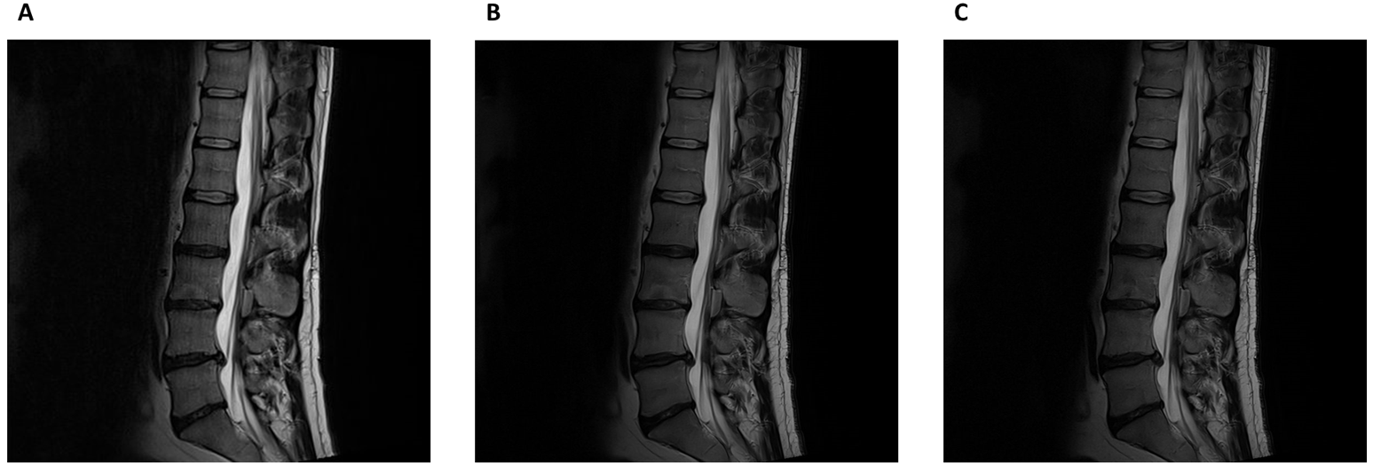 Case study 4: Deep Resolve Boost in lumbar spine imaging on Siemens Sola (XA51)