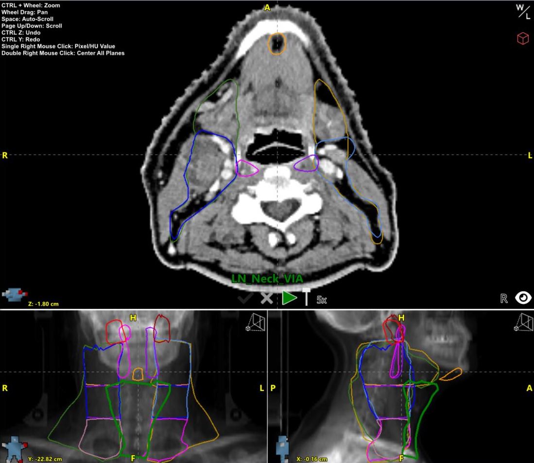 Automated Precision: The Revolution Enhancing Treatment Planning Workflows